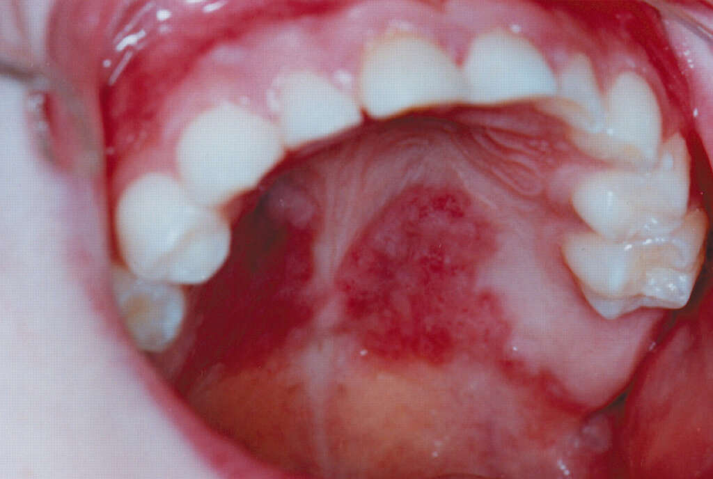 Geographic Tongue