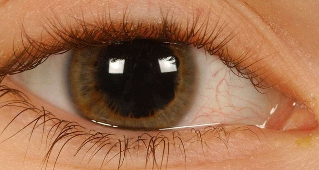 Glaucoma