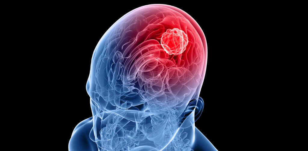 Glioblastoma