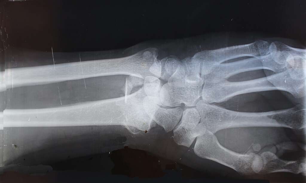 Golfer's Elbow