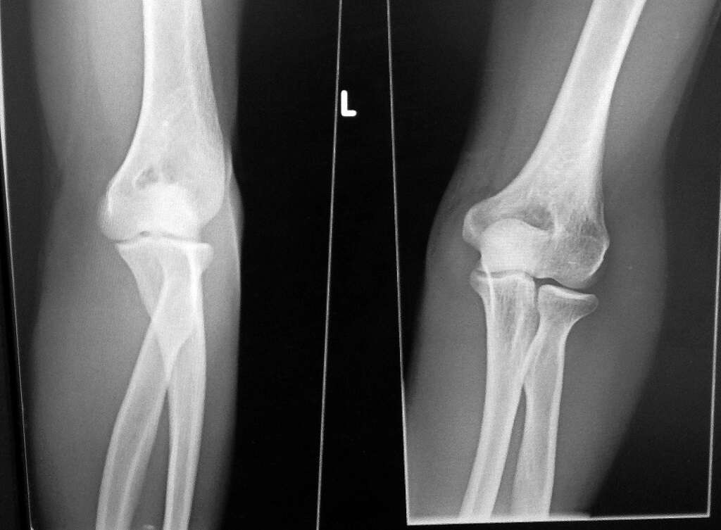 Golfer's Elbow