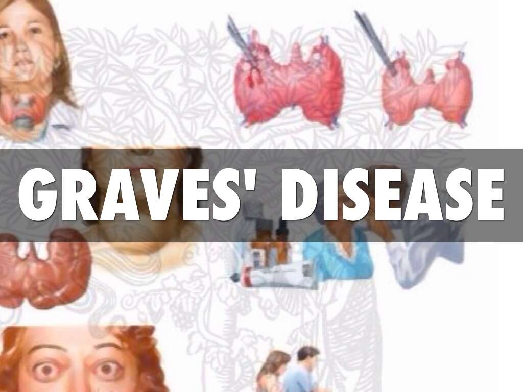 Graves' Disease