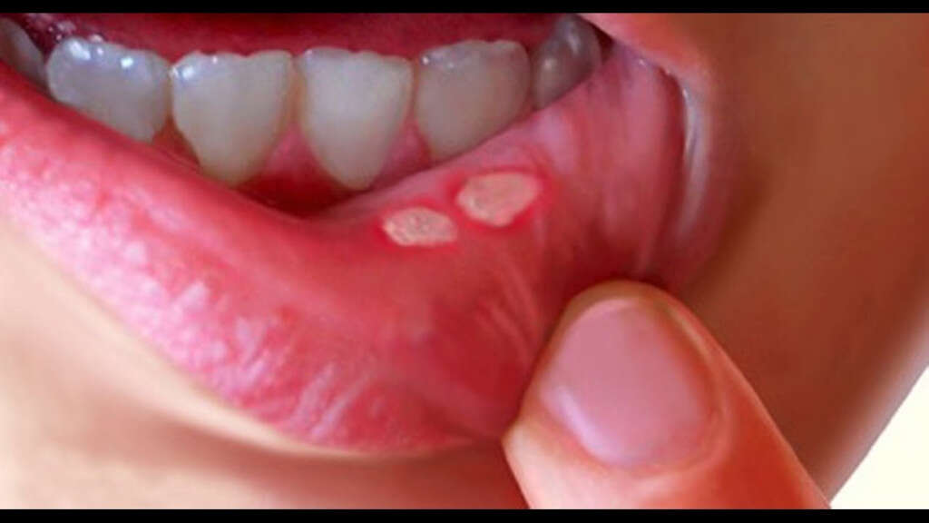 Hand Foot And Mouth Disease
