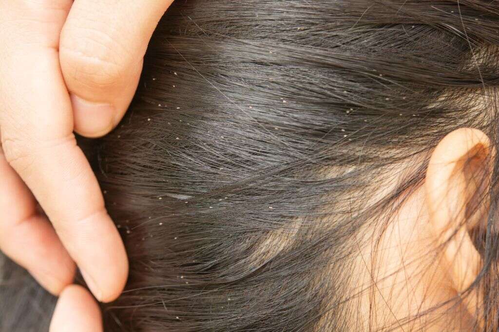 Head Lice