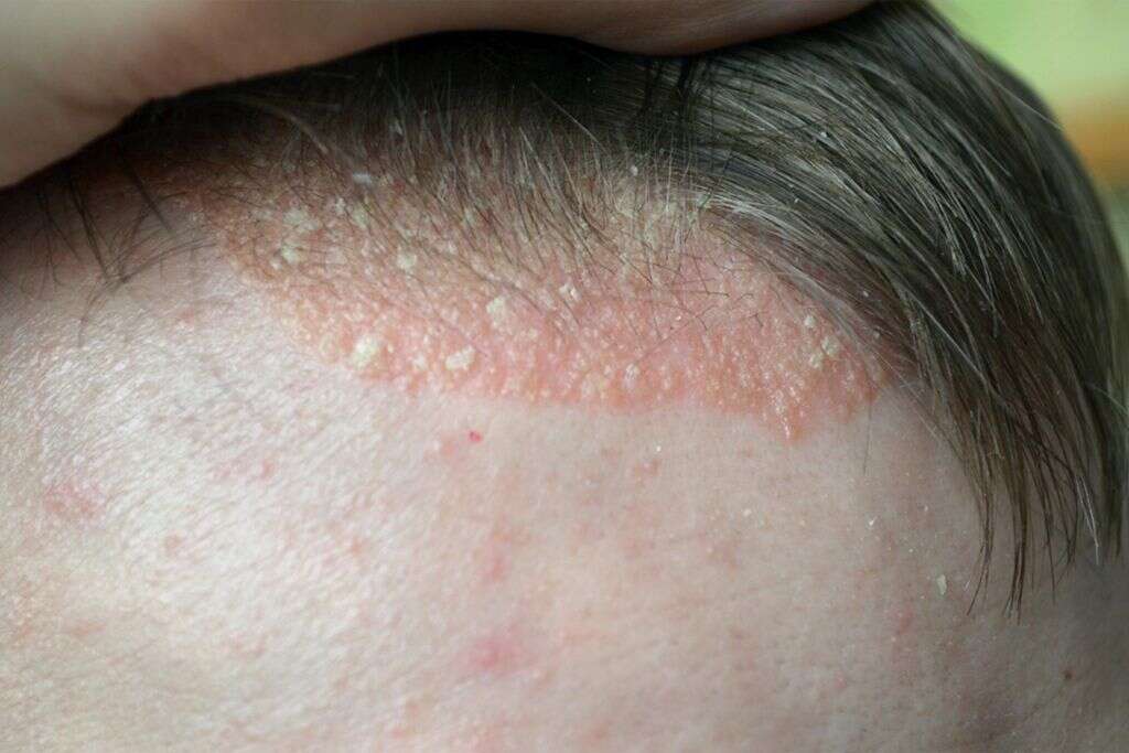 Head Lice