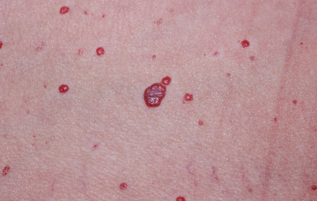 Hemangioma