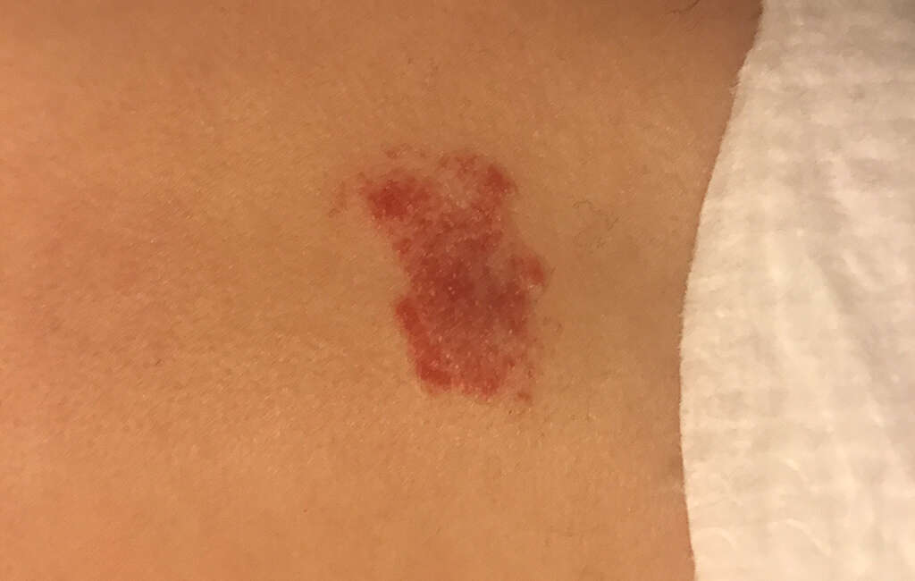 Hemangioma