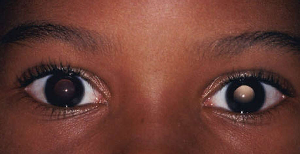 Hemangioma