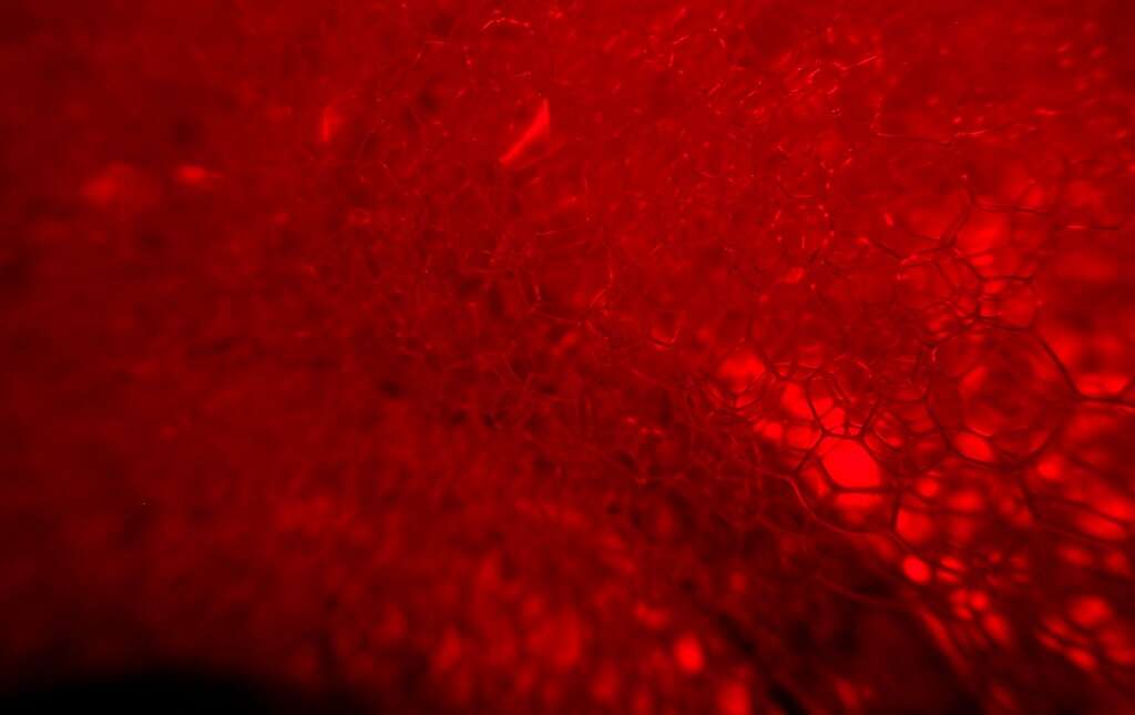 Hemoptysis
