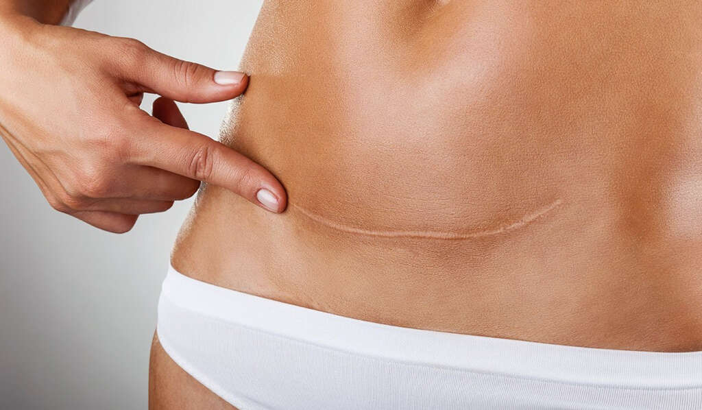 Hiatal Hernia