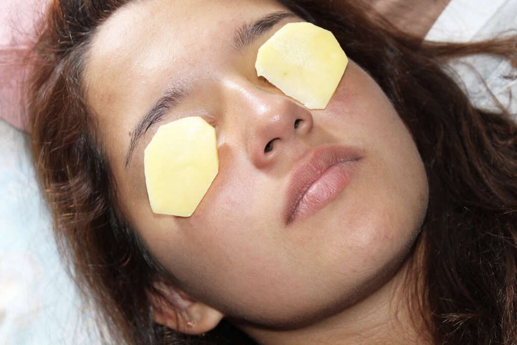 Bags Under Eyes