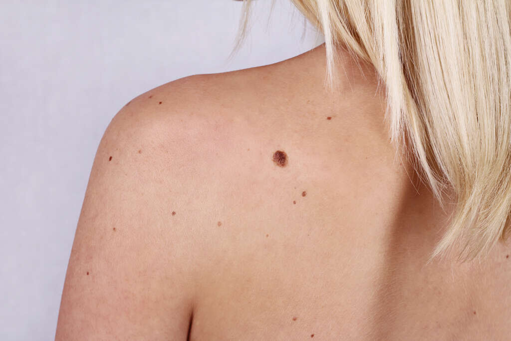 Skin Tags