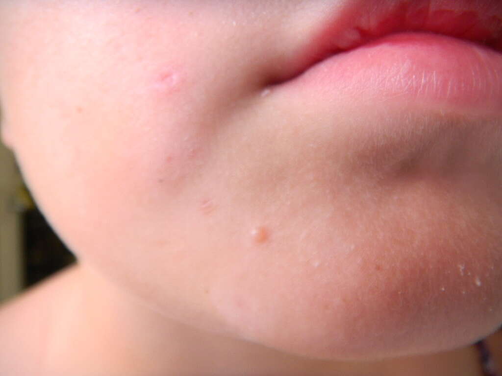 HPV