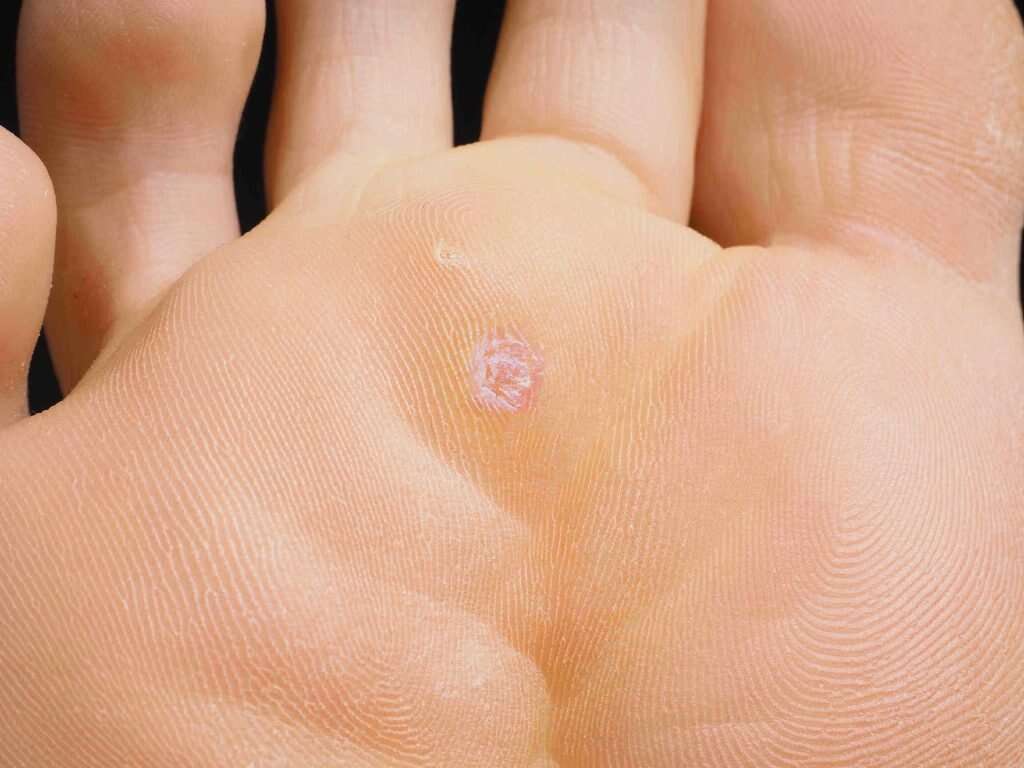 HPV