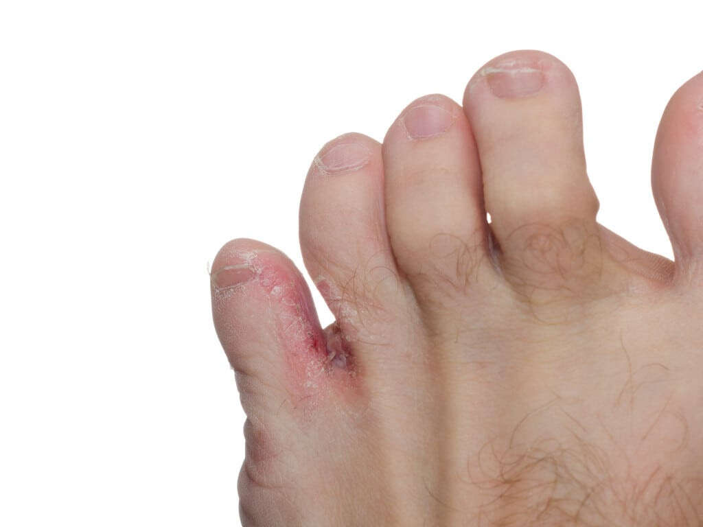 Hyperhidrosis