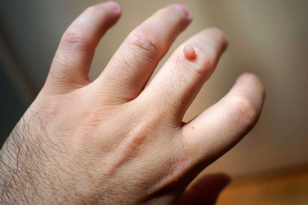 Hyperhidrosis