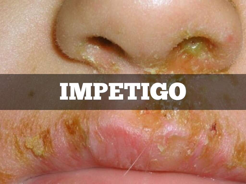 Impetigo Impetigo Causes Symptoms And Treatments