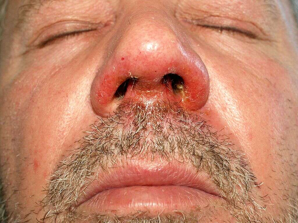 Impetigo