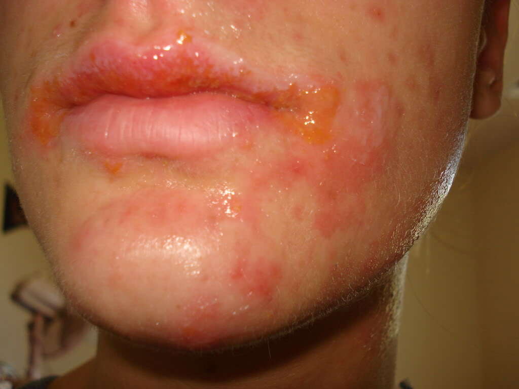 Impetigo