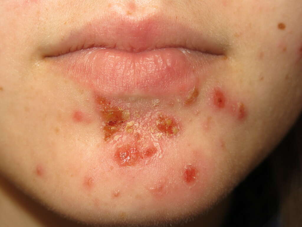 Impetigo