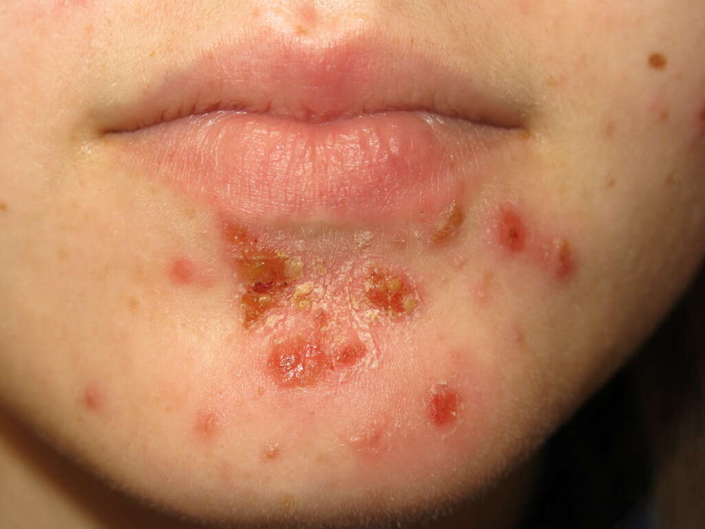 Impetigo Impetigo Causes Symptoms And Treatments