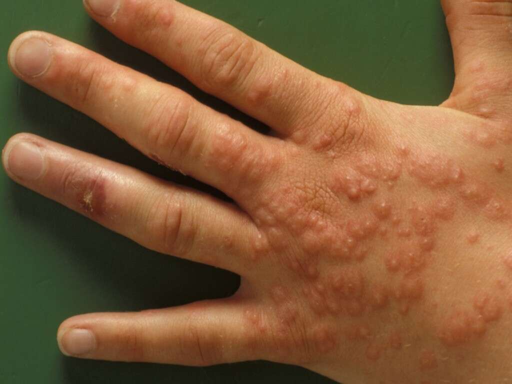 Impetigo