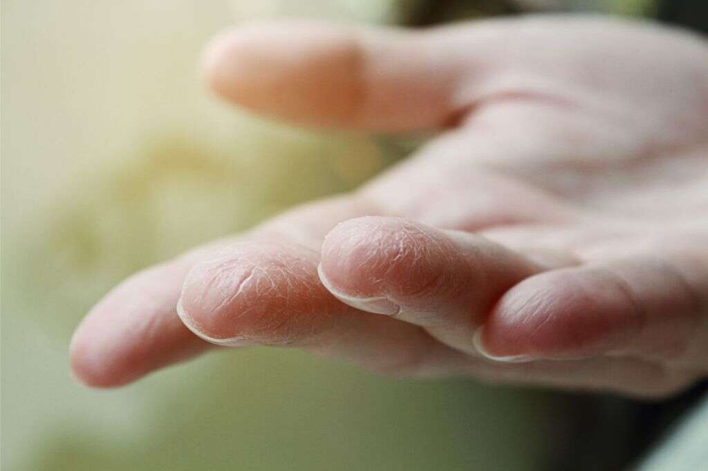 Iodine Deficiency