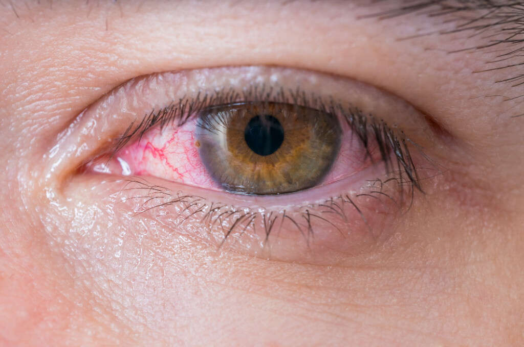 Leptospirosis