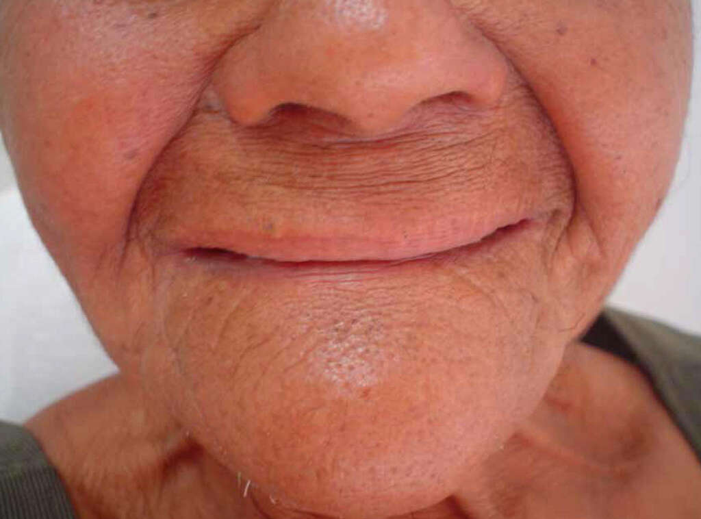 Lipoma
