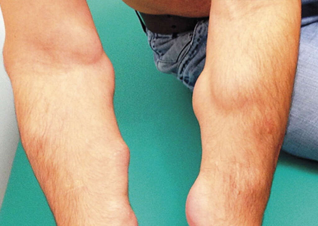 Lipoma