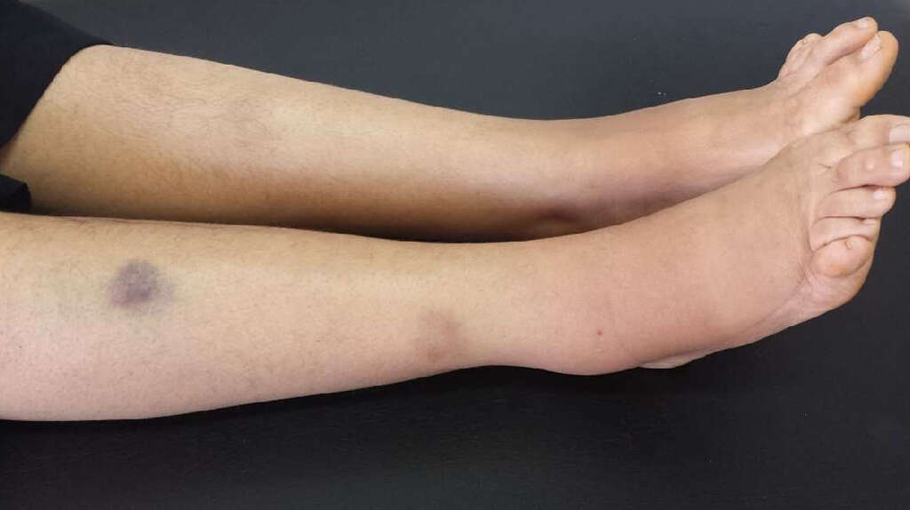 Lipoma