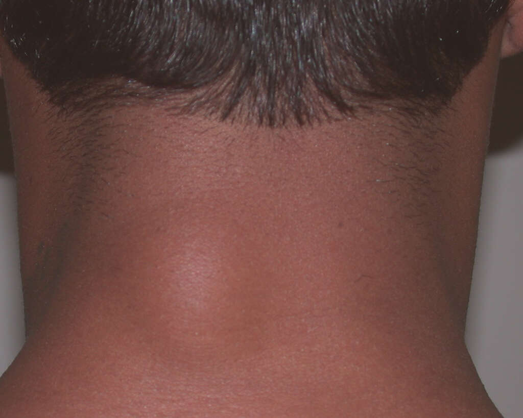 Lipoma