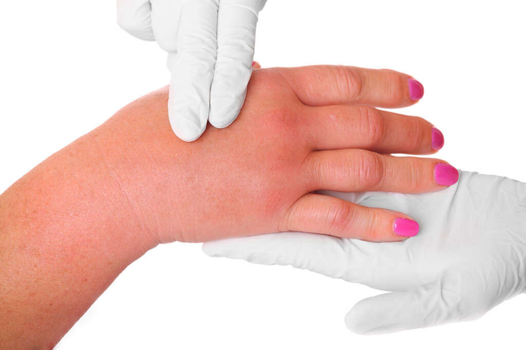 Lymphedema