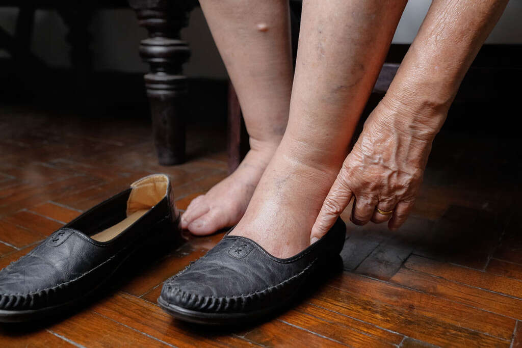 Lymphedema