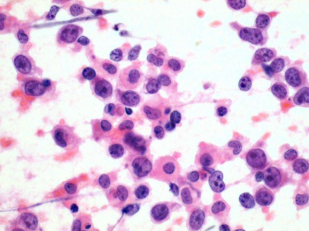 Lymphoma: Lymphoma Causes