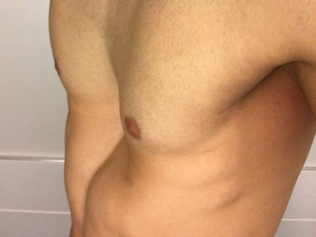 Marfan Syndrome