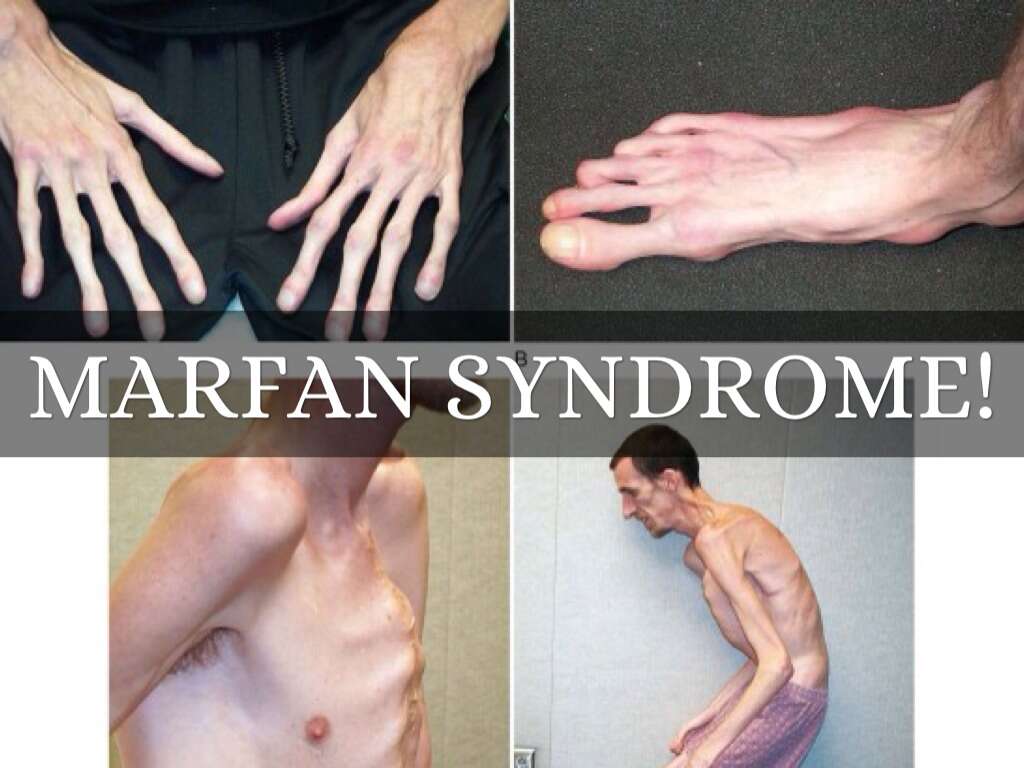 Marfan Syndrome