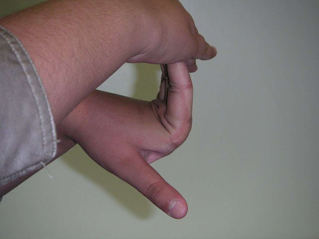 Marfan Syndrome