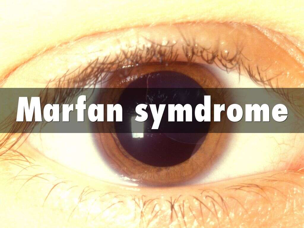 Marfan Syndrome