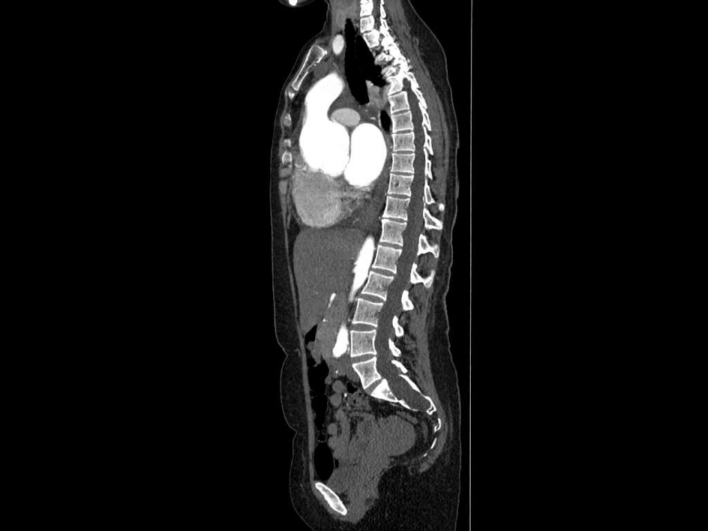 Marfan Syndrome