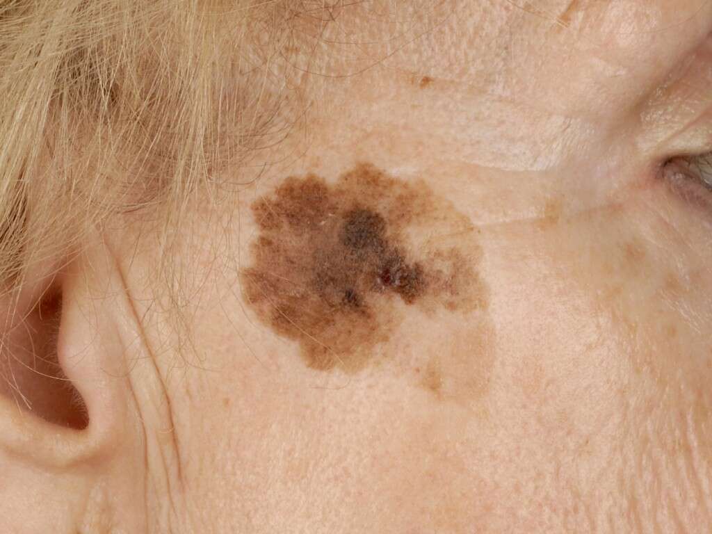 Melanoma
