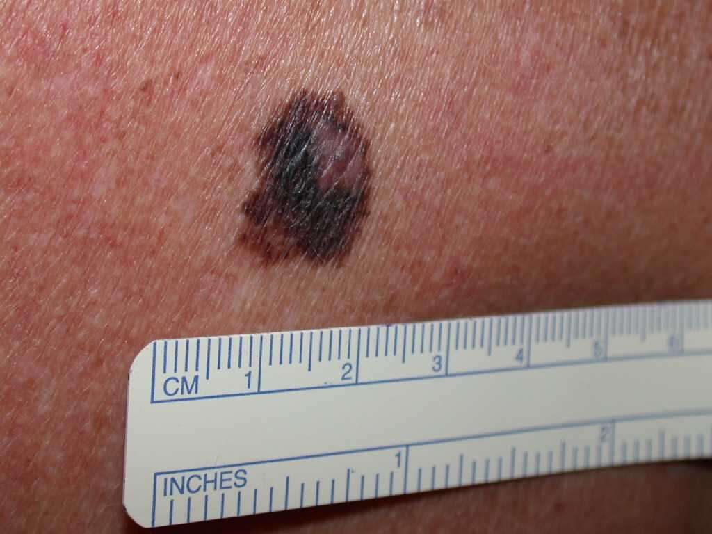 Melanoma