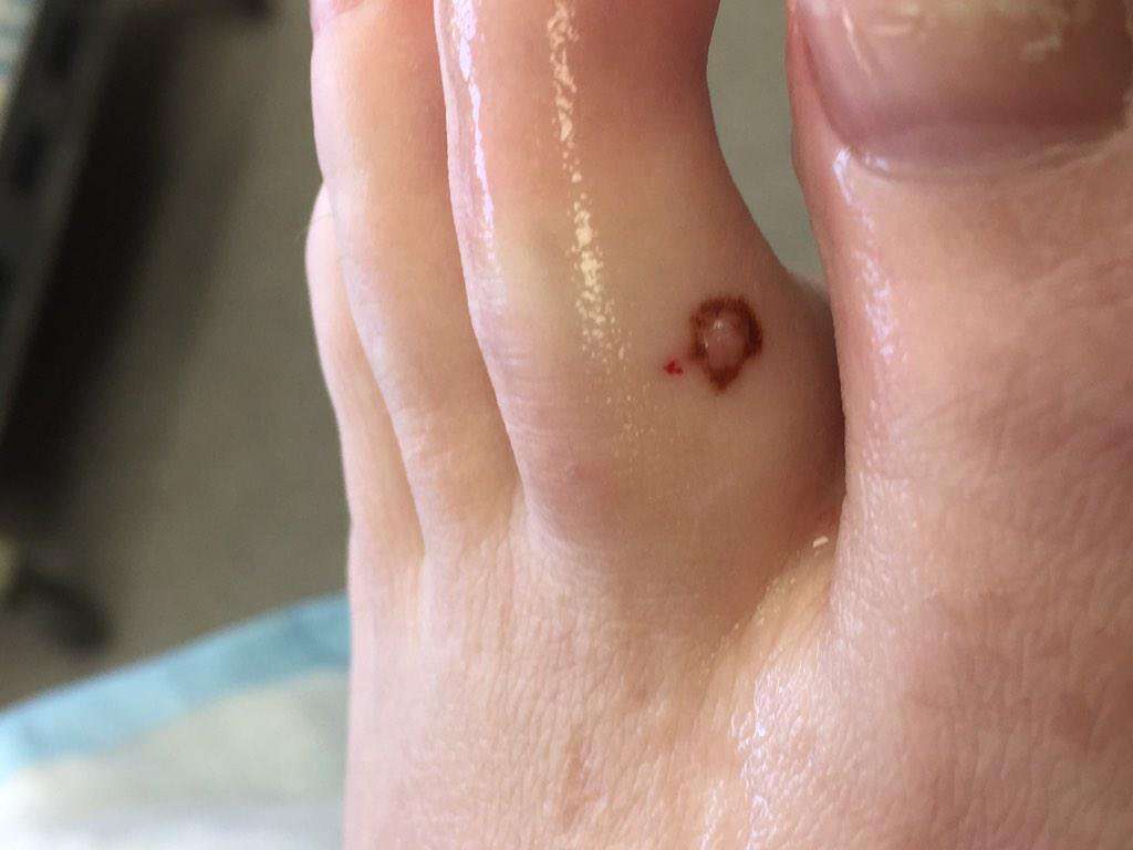Melanoma