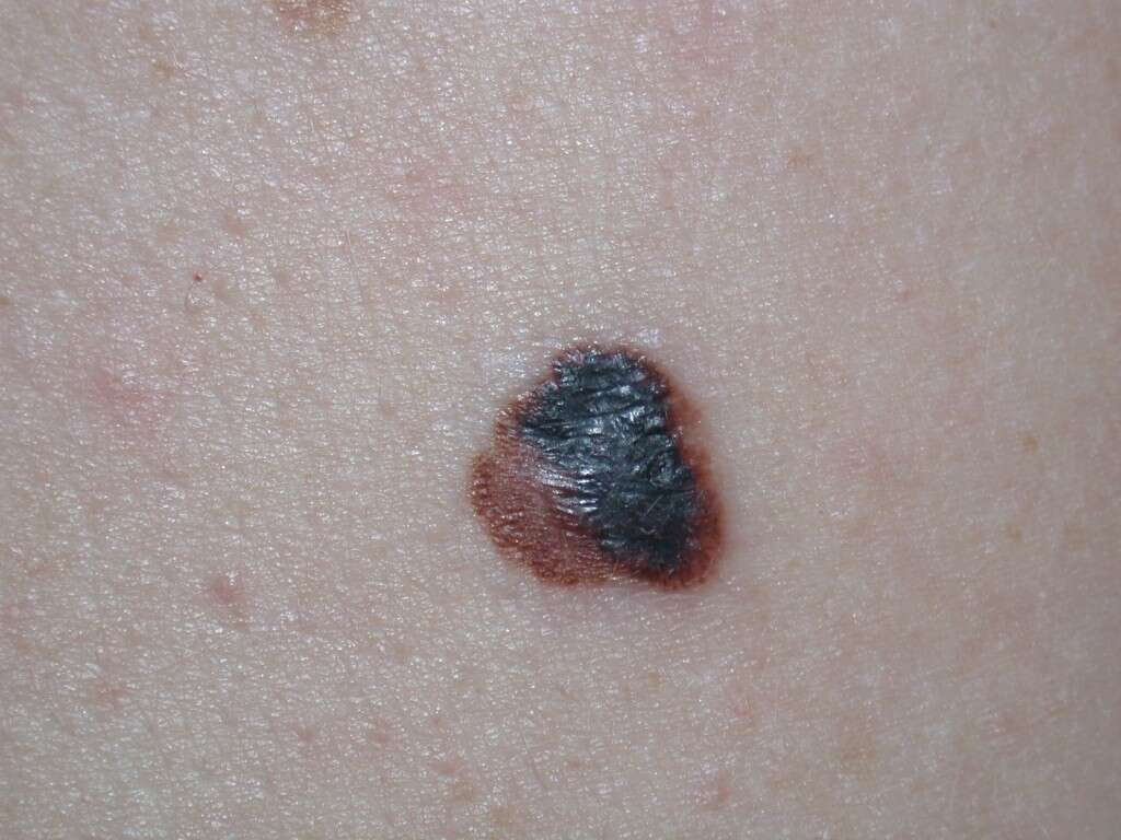 Melanoma