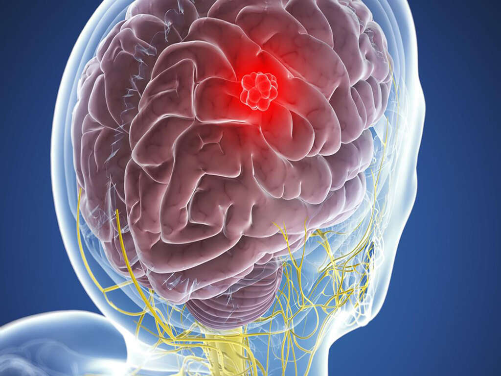 Meningioma