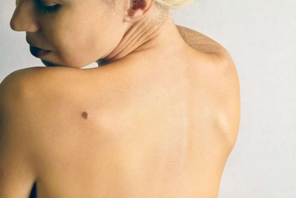 Molluscum Contagiosum