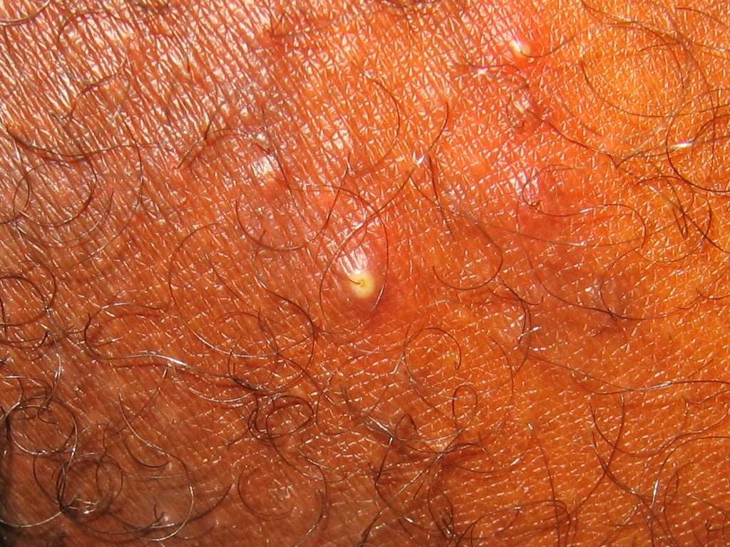 MRSA