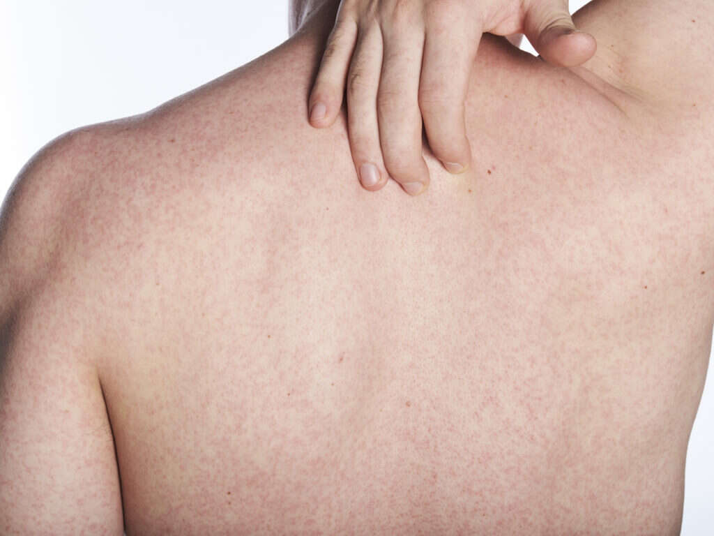 Multiple Sclerosis