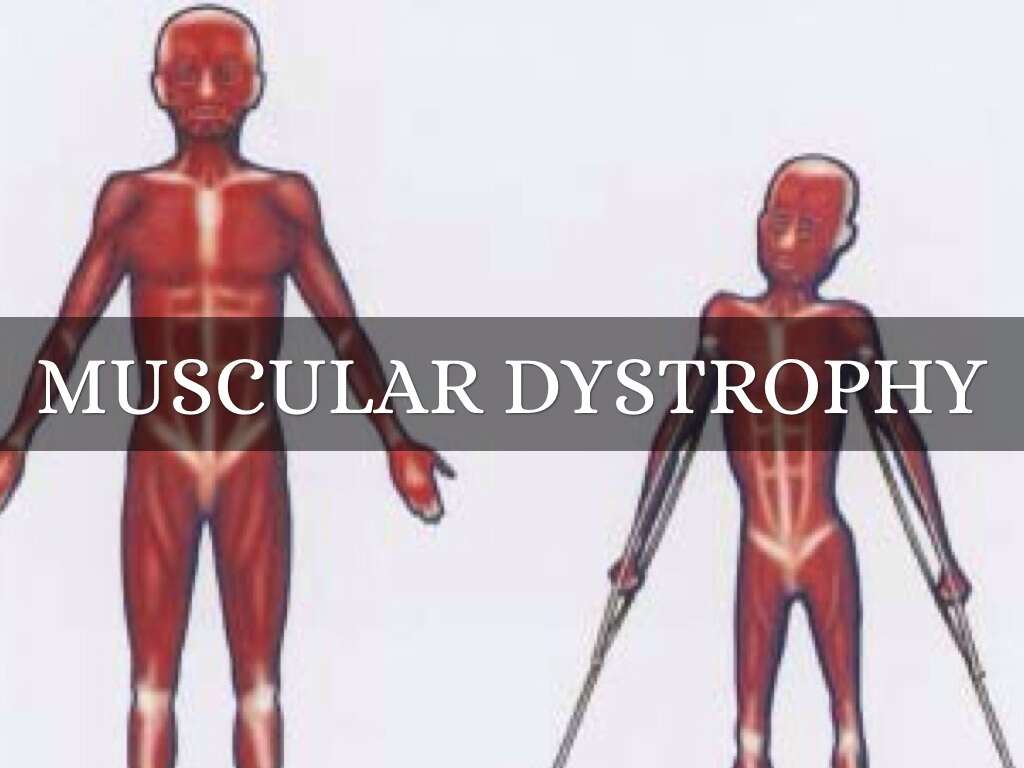 Muscular Dystrophy
