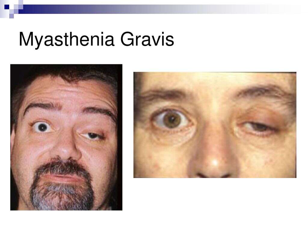 Myasthenia Gravis